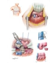 Lung Transplant