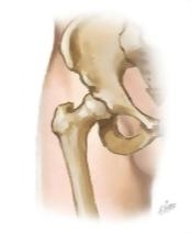 Cross Section Reference Hip: Axial - Axial Oblique-Sagittal
