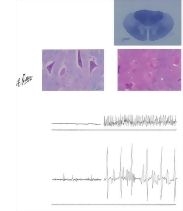 Primary Motor Neuron Disease