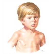 Child With Cervical Lymphadenitis Secondary to Nontuberculosis