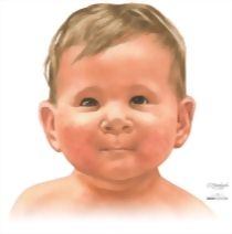 Clinical Presentation of Epstein-Barr Virus