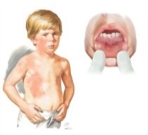 Pathogenesis and Clinical Presentation of Herpes Simplex Viruses