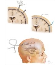 Intensive Medical Management of Severe Head Injury