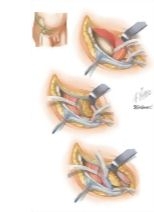 Surgical Approaches: Ilioinguinal Approach
