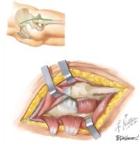 Surgical Approaches: Kocher-Langenbeck Approach