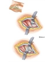 Surgical Approaches: Anterior (Smith-Peterson) Approach to Hip