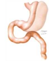 Treatment of Morbid Obesity