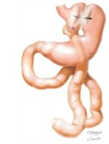 Complications of Bariatric Surgery