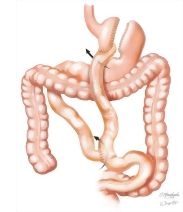 Complications of Bariatric Surgery