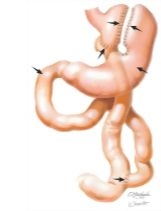 Complications of Bariatric Surgery