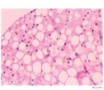 Nonalcoholic Steatohepatitis