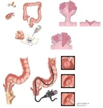 Neoplasms of the Large Bowel: Screening and Treatment of Colon Polyps