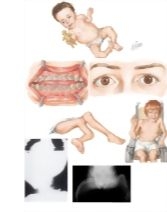 Osteogenesis Imperfecta