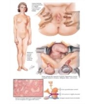 Male Pseudohermaphroditism II