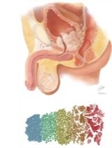 Carcinoma of Prostate I