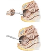 Operative Vaginal Delivery