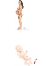 Intrauterine Growth Restriction