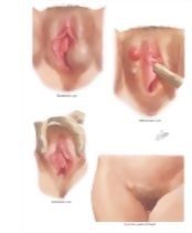 Multiple vaginal canals