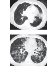 Radiologic Examination of the Lungs