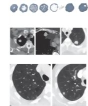 Radiologic Examination of the Lungs
