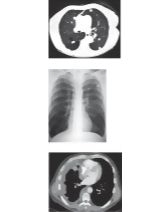 Radiologic Examination of the Lungs