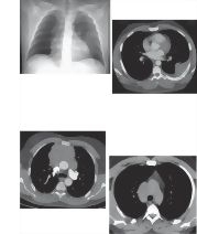 Radiologic Examination of the Lungs