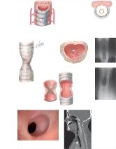 Laryngeal and Tracheal Stenosis