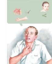 Bronchial Asthma