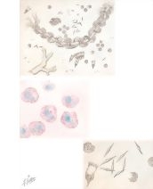 Bronchial Asthma