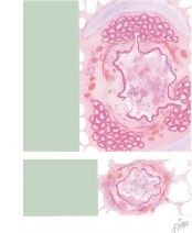 Chronic Obstructive Pulmonary Disease