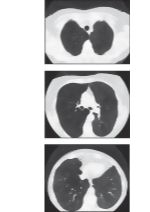Chronic Obstructive Pulmonary Disease