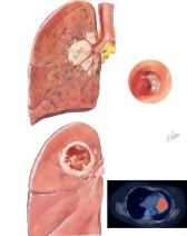 Squamous Cell Carcinoma of the Lung