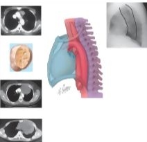 Mediastinal Tumors: Anterior Mediastinum