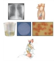 Testing for Suspected Hospital-Acquired Pneumonia