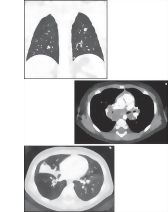 Histoplasmosis