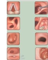 Bronchoscopic Views