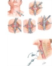 Tracheostomy