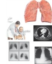 Embolism of Lesser Degree Without Infarction