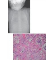 Respiratory Distress Syndrome