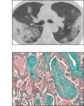 Cryptogenic Organizing Pneumonia