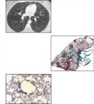 Lymphangioleiomyomatosis