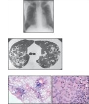 Pulmonary Langerhans Cell Histiocytosis