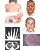 Sarcoidosis