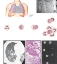 Systemic Lupus Erythematosus