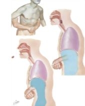 Upper Airway Obstruction and the Heimlich Maneuver
