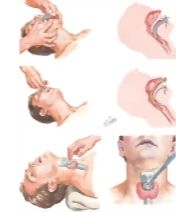 Securing an Emergent Airway