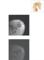 Cross Section of the Shoulder: Axial View