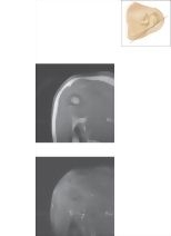 Cross Section of the Shoulder: Coronal View