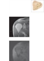 Cross Section of the Shoulder: Coronal View