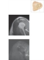 Cross Section of the Shoulder: Sagittal View